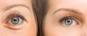 Find out whether Botox can help reduce under-eye bags and discover other innovative treatments to rejuvenate your appearance and reduce puffiness.
