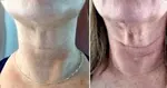 What turkey neck before and after looks like. How can you get rid of it? See my before and after pictures. Lean the causes of saggy neck skin and how to fix it