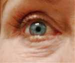 crepey under eye skin