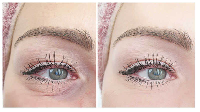 Tear trough deformity before and after fillers.