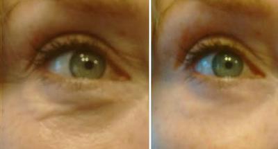 Eye Treatment Eyelid Lift Cream