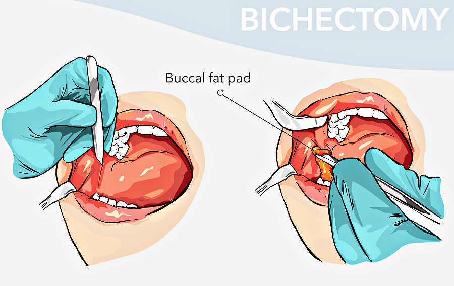 Buccal fat extraction surgery. Buccal fat diagram. buccal fat surgery