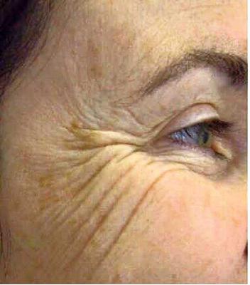 Botox causes cheek wrinkles?