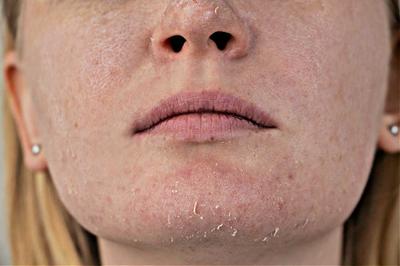 Vaseline for over exfoliated skin