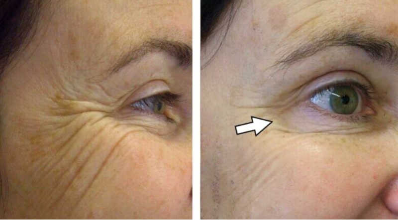 Side-by-side photo showing hollow cheeks and unnatural smile lines caused by Botox injected too close to the outer eyes and cheeks