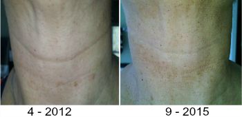 can vitamin C serum help treat turkey neck