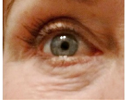 eye wrinkles and puffiness