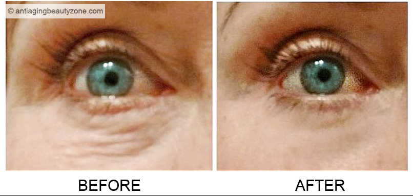 Under eye puffiness before and after using over the counter under eye serums that instantly tighten and lift.