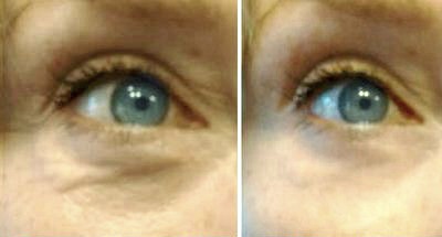 quick remedy to get rid of under eye bags