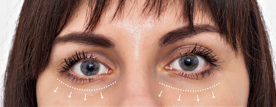 malar fat pads displacement malar fat pads falling