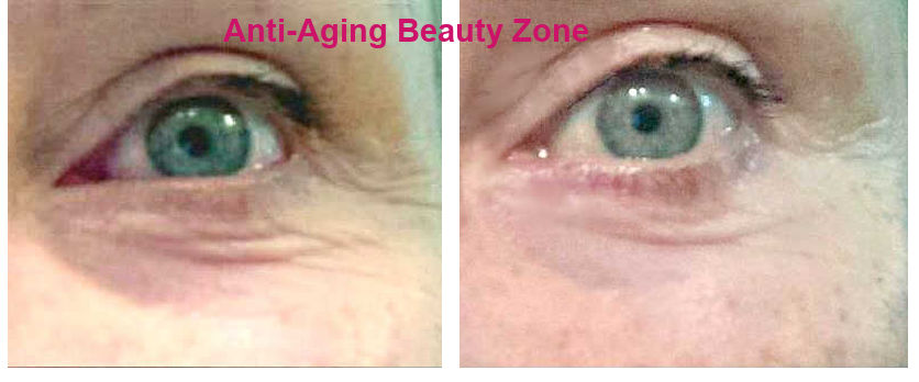 Before and after eye wrinkle improvement from face massages. Before and after picture of eye wrinkles. Improvements after 6 months of daily face lift massages.