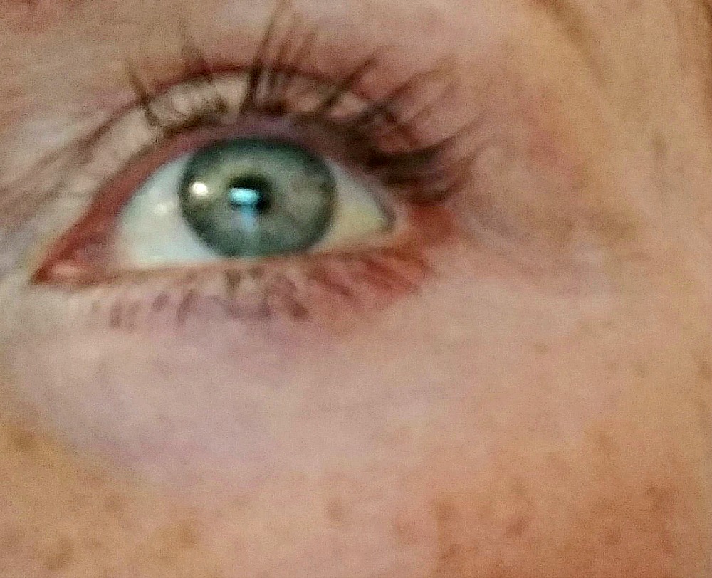 lines under eyes at 16