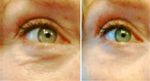 Before and after pictures of puffiness and cross-hatching lines under the eyes. Criss-cross lines under eyes and under-eye puffiness before and after pictures.