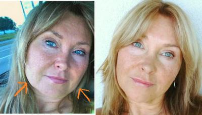 sagging face jowls cheeks fix skin facial around jawline lift exercises before jowl exercise lower surgery aging without firm facelift