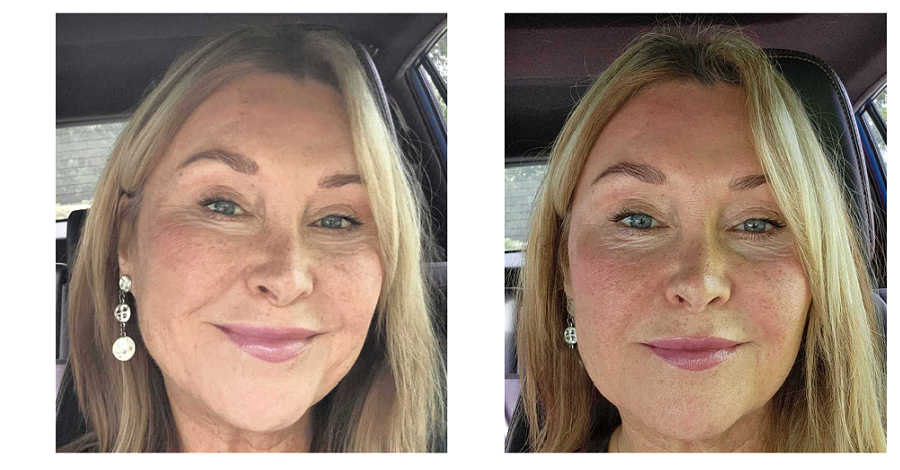 LifeCell Before and After