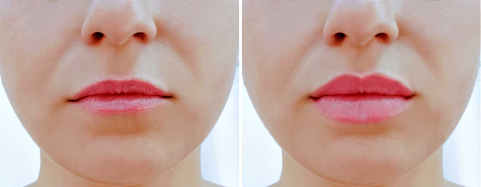 lip filler benefits before and after