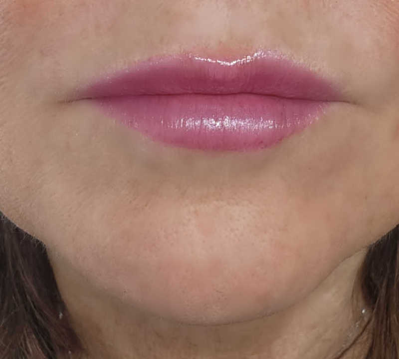 10 days after 4-unit Botox lip flip on thin lips — subtle upper lip curl