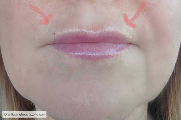 Right after lip flip injection—what it looks like before the results settle. Lip flip results immediately after Botox injection—slight swelling, no filler used.