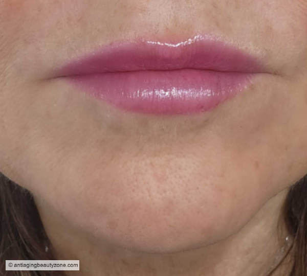 10 days after lip flip—see the natural-looking lift without added volume. Lip flip results 10 days after Botox injection—subtle lift and natural shape.