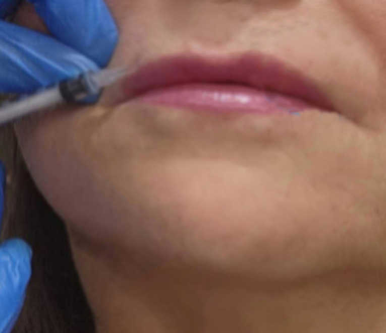 Before lip flip photo with thin lips during Botox injection — no filler used