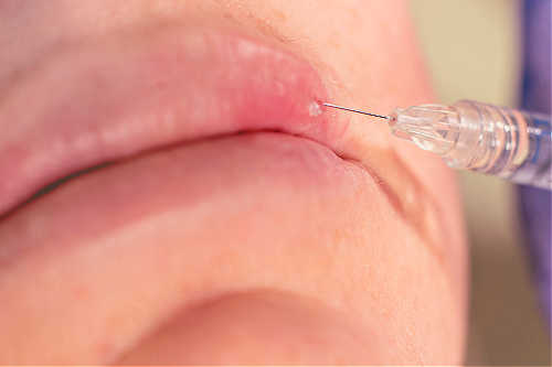 Lip injection close up.