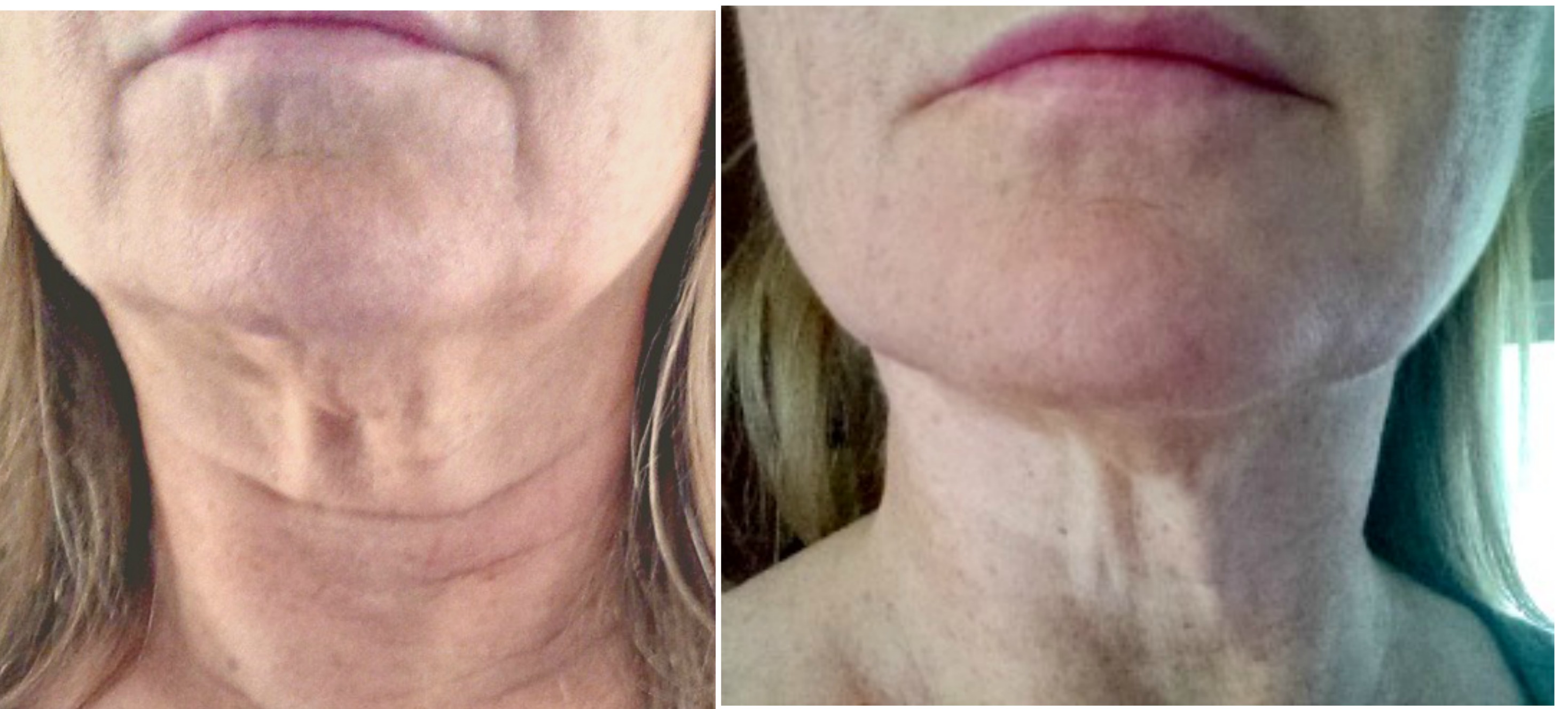 Results of jowl exercises before and after.