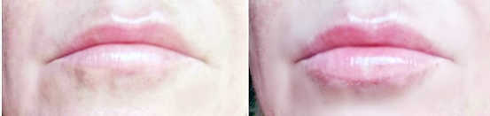 my lips before and after filler