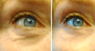 puffy under eye - before and after