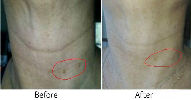 Neck without spots before and after results.
