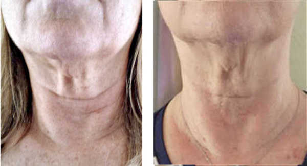 neck before