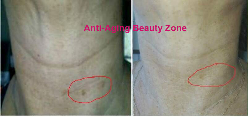 Before and after photo showing improved neck wrinkles and faded brown spots after consistent face massage and homemade vitamin C serum