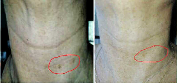 neck brown spot