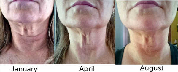 My lower face and neck results from January to April to August using Carolyn’s Facial Fitness