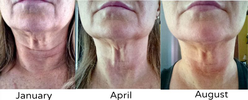 Results with neck tightening exercises.
These neck exercises even helped firm up crepey neck skin.