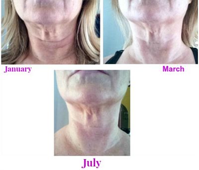 face slimming exercises before and after under skin