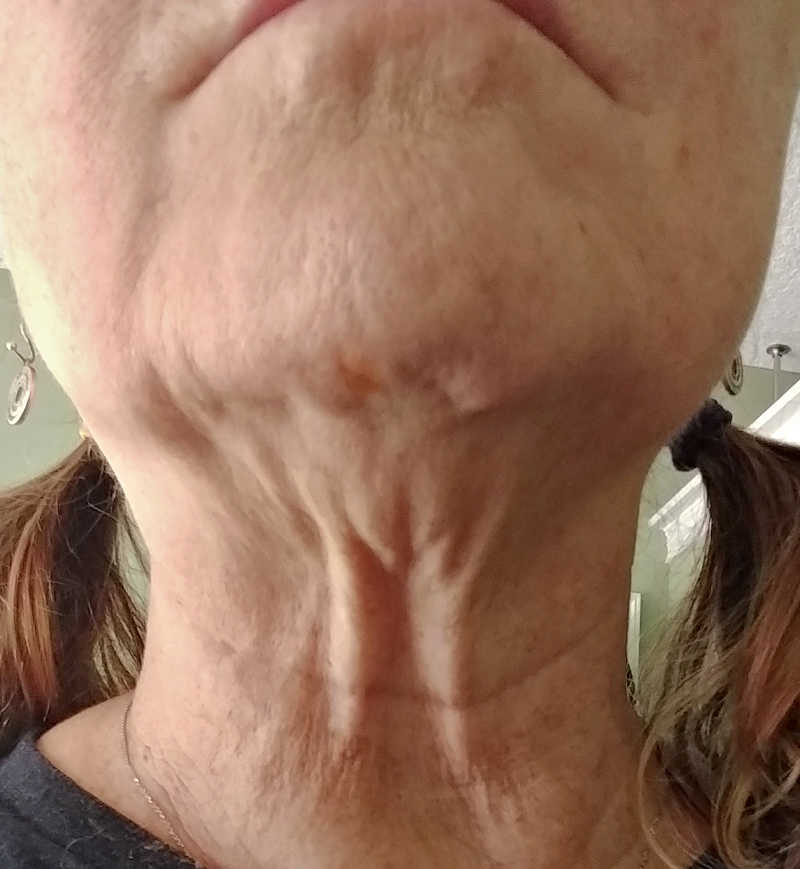 facial exercises to tighten a double chin Double chin has many different looks.