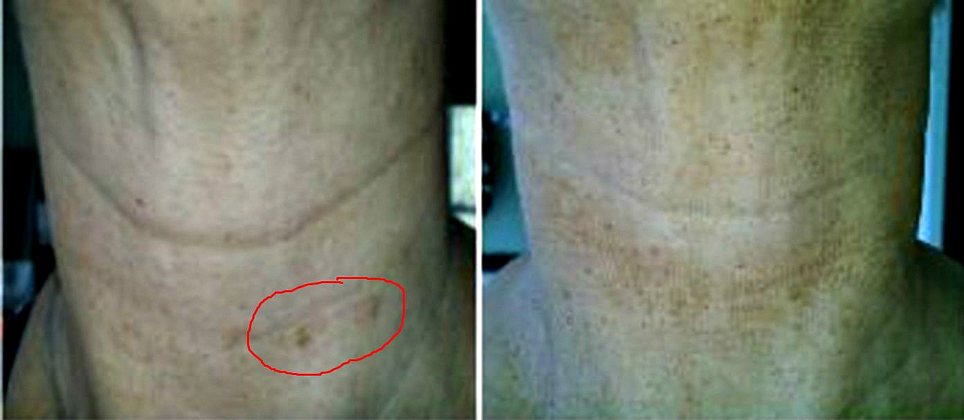Spots on neck. how to reduce sun spots on skin with vitamin C lightening treatments