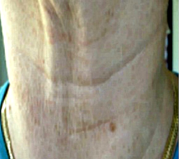 Before picture of my sagging neck with sun spots and wrinkles. Sagging neck skin.