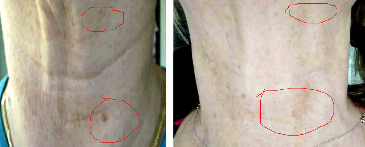 How to lighten and fade sun spots