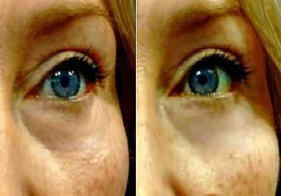 My best eye wrinkle treatment