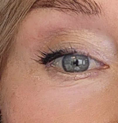Plexaderm under-eye result after about 8 hours, showing more visible residue and slight caking near the outer corner