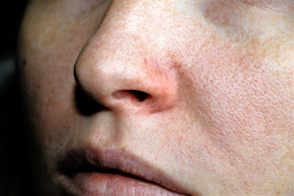 What Is The Yellow Stuff That Comes Out Of Pores at Arthur Sessums blog