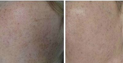 Roloxin review before picture.