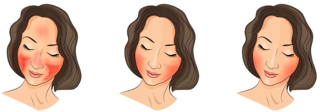 flushed face rosacea