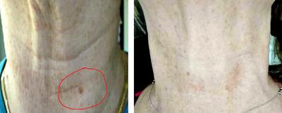 Vitamin C cream for neck wrinkles