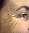 Upper-cheek wrinkles after crow’s-feet Botox