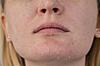Vaseline for over exfoliated skin