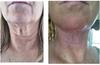 exercise to tighten face skin