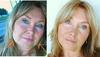 Sagging Cheeks and Jowls: What Facial Exercises Did for Me