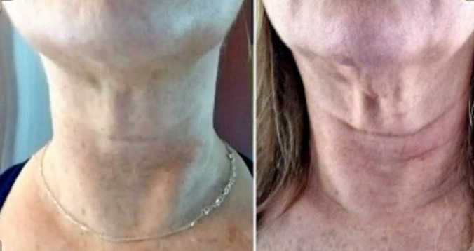 turkey neck after and before
